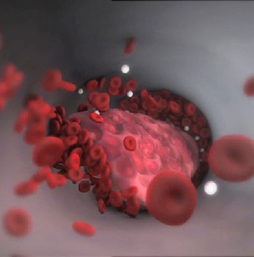 Thrombophilia: Huyết khối tĩnh mạch di truyền